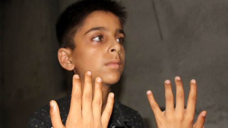 У Файзана Ахмада Наджары из Индии по шесть пальцев на каждой руке | Фото: SWNS