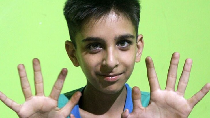 У Файзана Ахмада Наджари з Індії по шість пальців на кожній руці