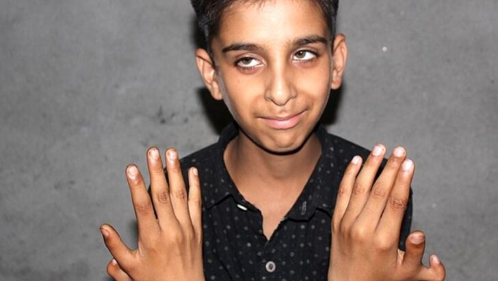 У Файзана Ахмада Наджары из Индии по шесть пальцев на каждой руке | Фото: SWNS
