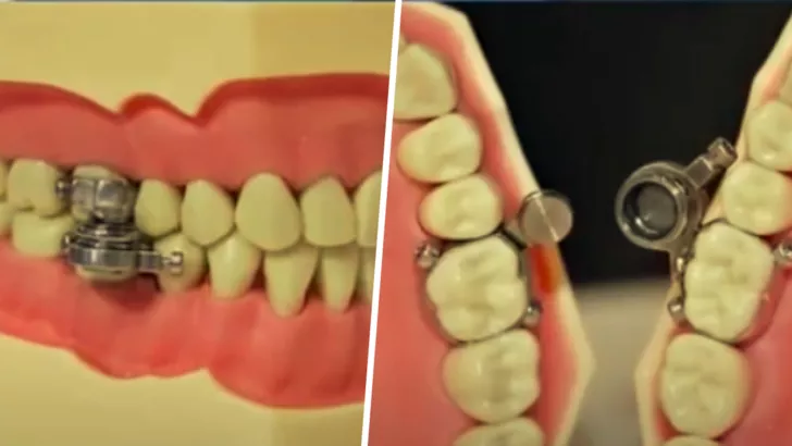 Ученые создали магнитный замок на рот для похудения