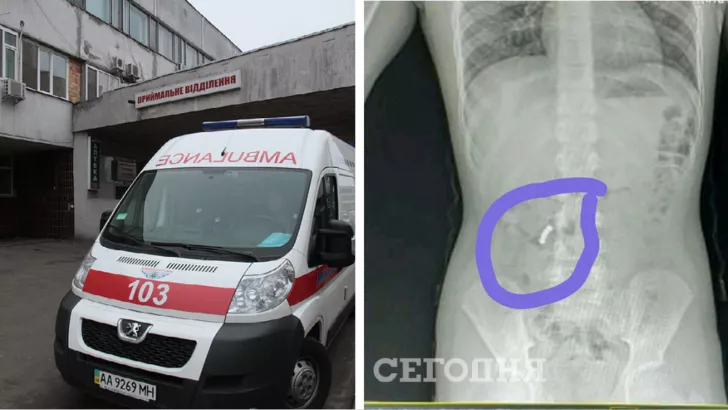 Под Одессой в больницу попал мальчик, который проглотил четыре магнита.