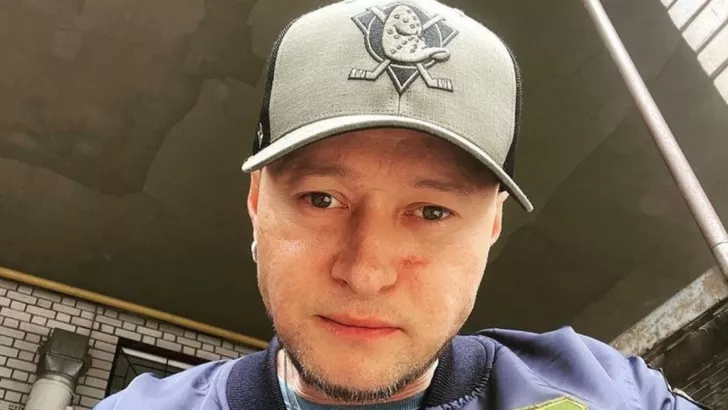 Андрей Хлывнюк планирует выставить на аукцион осколок, ранивший его лицо