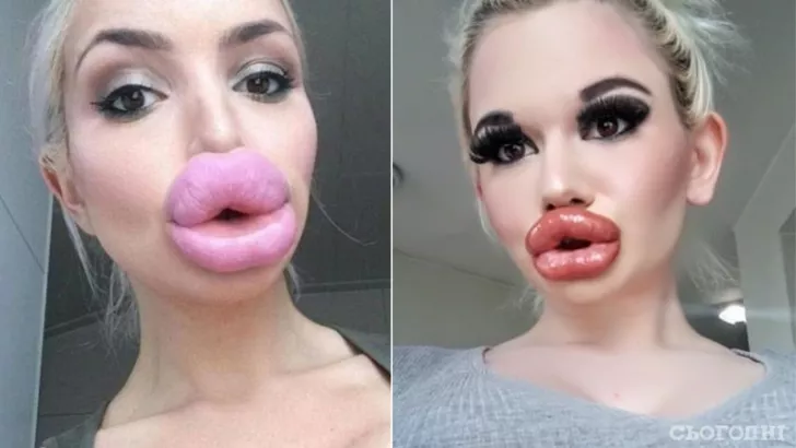 10 женщин, переборщивших с ботоксом в губах