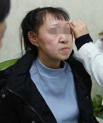 Сяо Фэн обзавелась новой внешностью | Фото: Shenyang Sunline Plastic Surgery Hospital