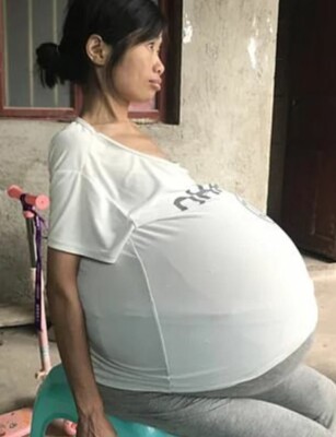 У 36-летней Хуан Госянь живот раздулся до аномальных размеров | Фото: Guizhou Urban Daily