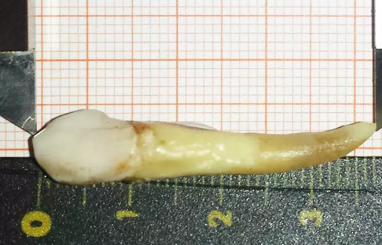 Пациенту удалили самый длинный в истории зуб