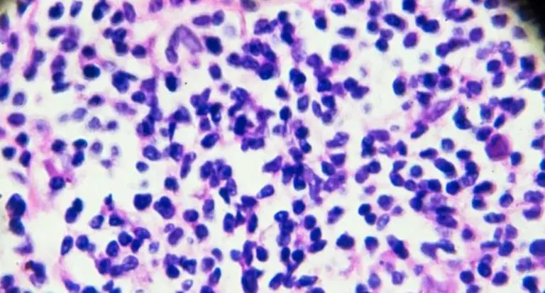 Так выглядят клетки лимфомы Ходжкина