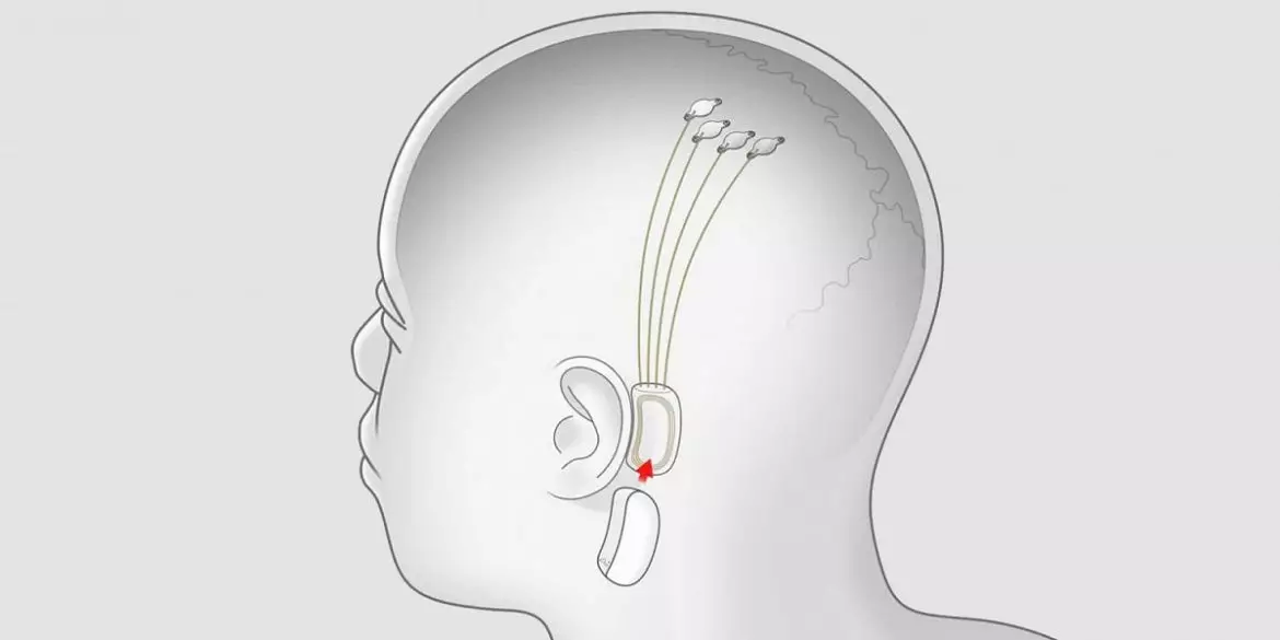 Расположение имплантов Neuralink в мозге человека