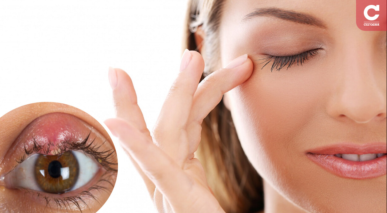 Ячмень на глазу: симптомы, лечение ячменя на верхнем и нижнем веке в домашних условиях