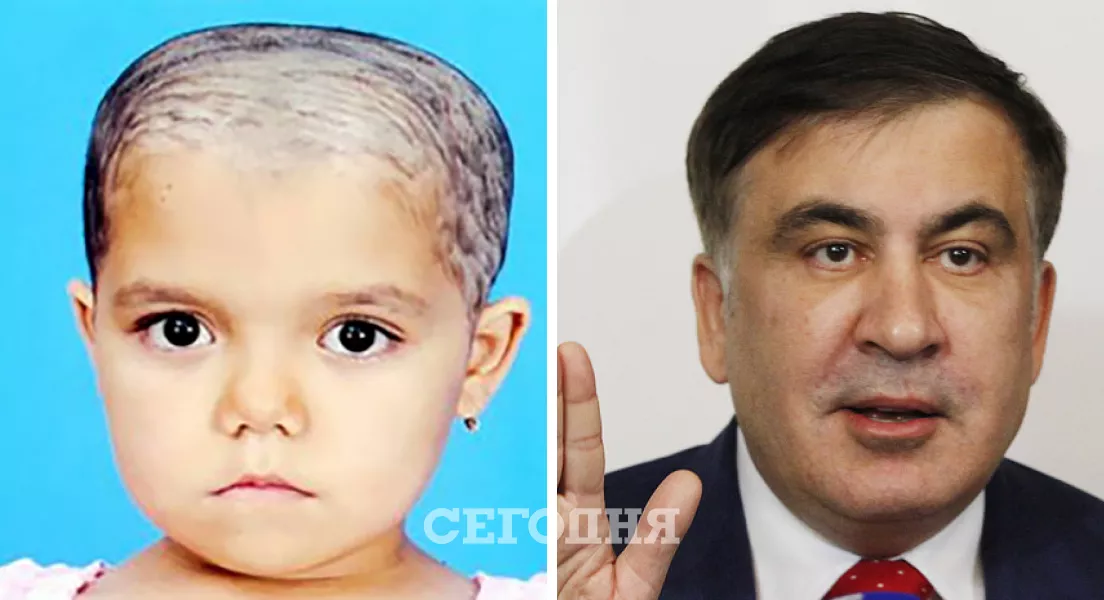 Форма черепа больного талассемией ребенка, фото которого мы взяли из медицинского учебника и Михеила Саакашвили схожи. Для страдающих этим заболеваниям характерна "башенная голова", приплюснутый нос, увеличенная верхняя челюсть.