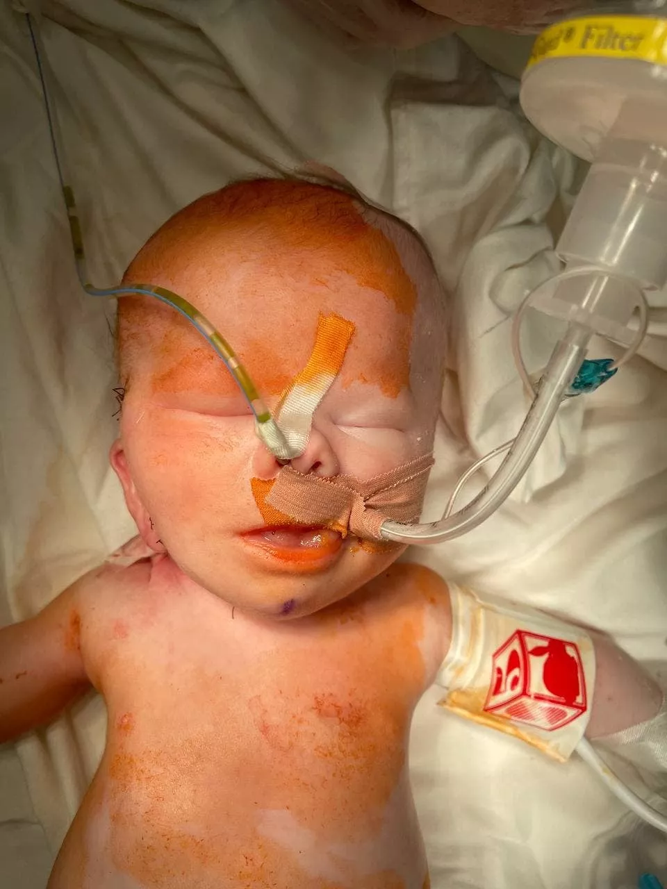 Слідів операції на тілі дитини майже не видно/Фото: Facebook: ДУ "Інститут педіатрії, акушерства і гінекології НАМН України"
