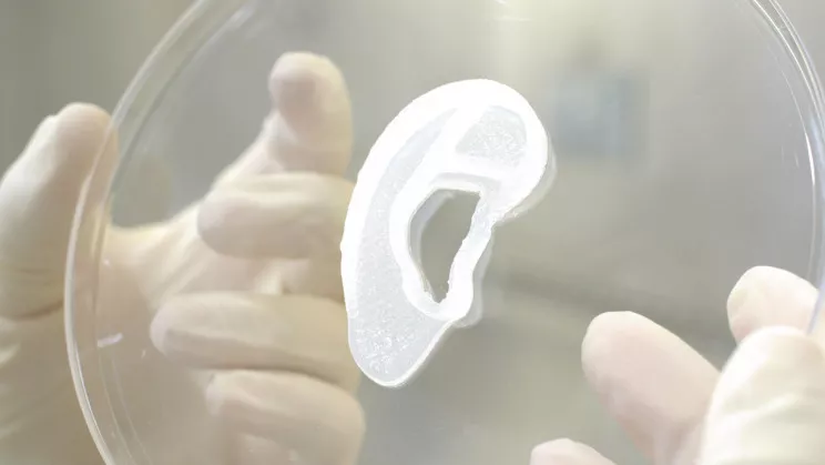 3D-печатное ухо было изготовлено по форме, которая точно соответствовала настоящему левому уху женщины