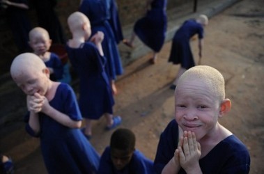 В Европе встречается один альбинос на 20 тысяч человек