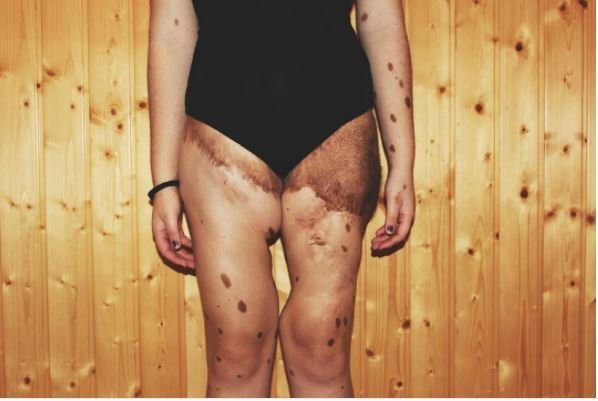 Тело 16-летней испанки Альбы Парео покрыто более 500 пятнами. Фото: instagram.com/albaparejo_<br />

