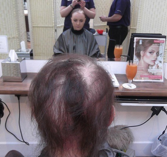 Девушка живет без волос. Фото: Facebook
