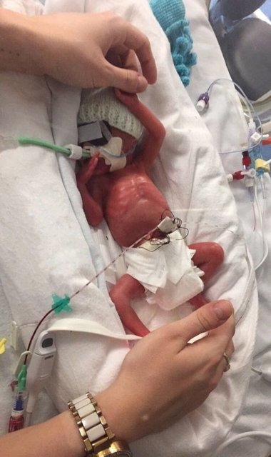 Близнецы чудом выжили после родов. Фото: Facebook