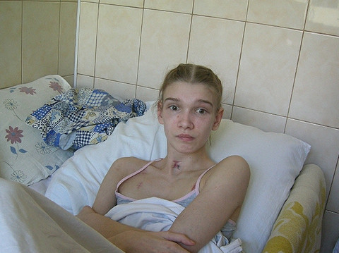 Александра Попова после двух месяцев комы. Фото: novosti-n.mk.ua 