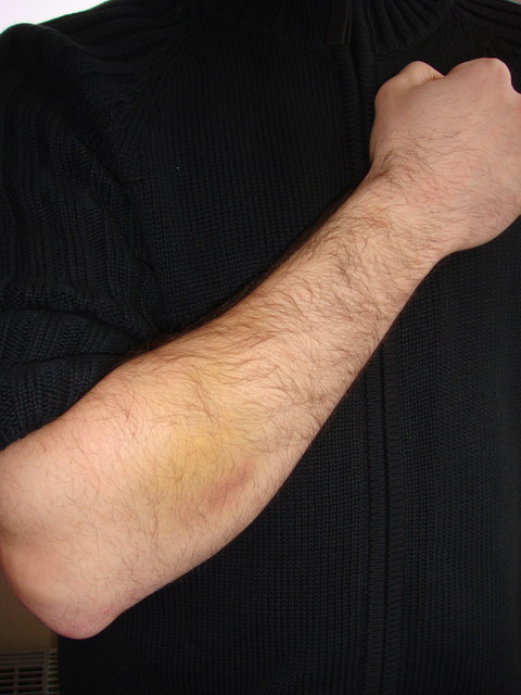 После избиения водителем АУДИ у Дмитрия – гематома на руке, ушиб левой половины грудной клетки, а также подкожная гематома правого предплечья