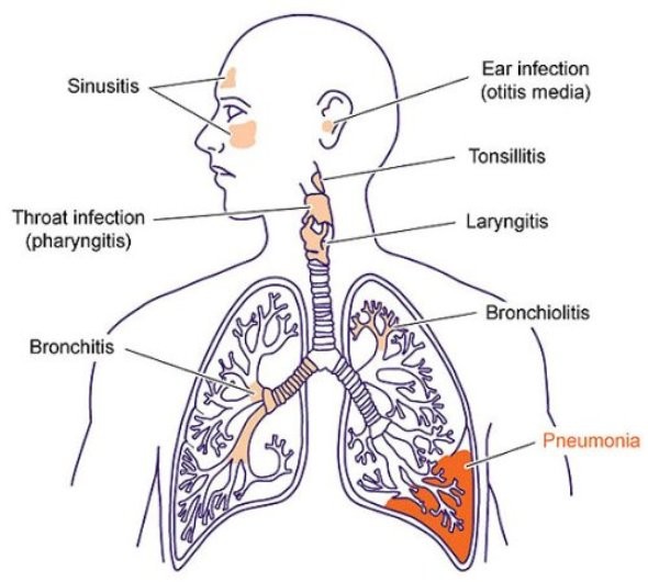 6. Пневмония<br />
Пневмония — воспаление лёгочной ткани, как правило, инфекционного происхождения с преимущественным поражением альвеол. Факторы, предрасполагающие к развитию пневмонии: курение и хронический бронхит, хронические болезни лёгких, эндокринные заболевания, сердечная недостаточность, хирургические операции грудной клетки и брюшной полости, алкоголизм, наркомания. С применением антибиотиков прогноз, как правило, благоприятный. Кишечная флора после приема антибиотиков, в большинстве случаев, восстанавливается самостоятельно и не требует применения препаратов. В случае неадекватной терапии или иммунодефицита пневмония может привести к летальному исходу.<br />

