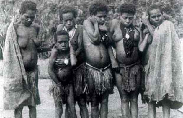 Болезнь Куру<br />
Куру — болезнь, встречающаяся почти исключительно в высокогорных районах Новой Гвинеи у аборигенов племени форе, впервые обнаружена в начале XX века. Болезнь распространялась через ритуальный каннибализм, а именно поедание мозгов болевшего этой болезнью. С искоренением каннибализма куру практически исчезла. Однако все еще появляются отдельные случаи, потому что инкубационный период может длиться более 30 лет. Главными признаками заболевания являются сильная дрожь и порывистые движения головой, иногда сопровождаемые улыбкой, подобной той, которая появляется у больных столбняком.<br />
