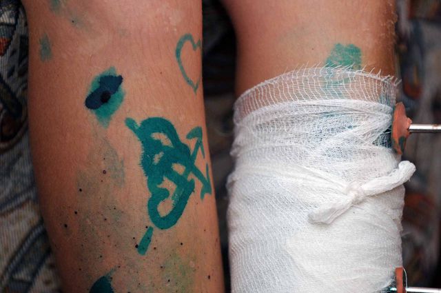 У Саши диагностировали многоосколочный перелом левой ноги и множественные ранения туловища и лица. Фото:  fdu.org.ua
