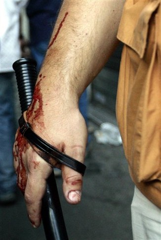 Окровавленная рука одного из полицейских. AP