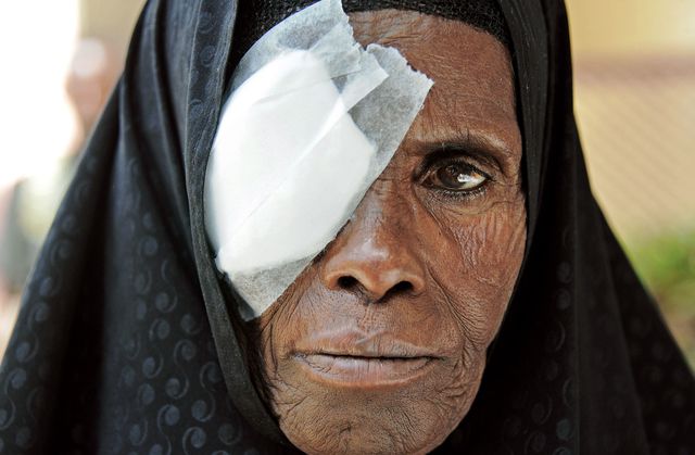Сомалийская женщина после операции по удалению катаракты. В Сомали значительное количество населения имеют проблемы со зрением, и катаракта является одной из главных причин его потери. Фото: AFP