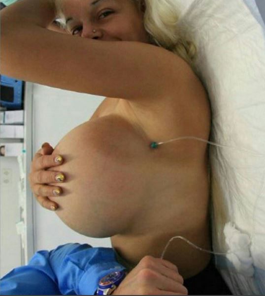 <p>Імпланти в грудях дівчина заповнює соляним розчином. Кадр з відео</p>