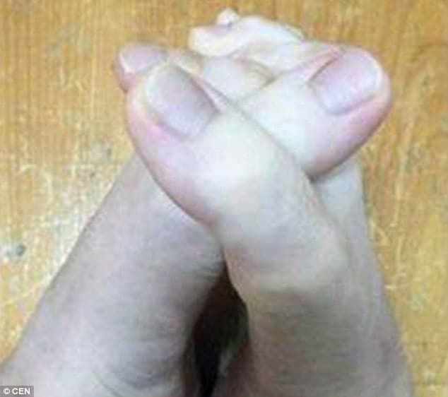 Перелом пальцев ног: признаки, симптомы, лечение